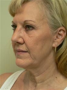 Facelift Before Photo by Daniel Casso, MD; Nassau Bay, TX - Case 25931