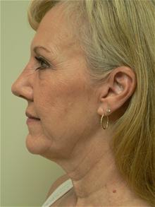 Facelift Before Photo by Daniel Casso, MD; Nassau Bay, TX - Case 25931