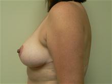 Breast Reduction After Photo by Daniel Casso, MD; Nassau Bay, TX - Case 25932