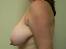 Breast Reduction Before Photo by Daniel Casso, MD; Nassau Bay, TX - Case 25932