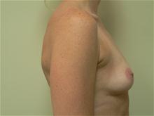 Breast Augmentation Before Photo by Daniel Casso, MD; Nassau Bay, TX - Case 25933