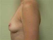 Breast Augmentation Before Photo by Daniel Casso, MD; Nassau Bay, TX - Case 25933