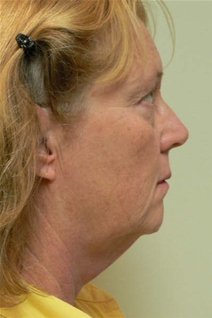 Facelift Before Photo by Daniel Casso, MD; Nassau Bay, TX - Case 7709