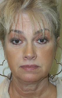 Facelift Before Photo by Daniel Casso, MD; Nassau Bay, TX - Case 7710