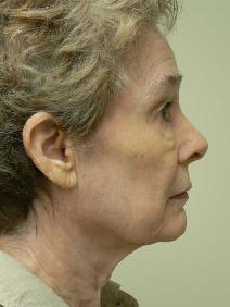 Facelift Before Photo by Daniel Casso, MD; Nassau Bay, TX - Case 7711