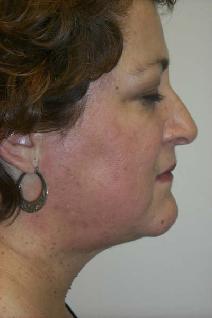 Liposuction After Photo by Daniel Casso, MD; Nassau Bay, TX - Case 7714