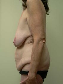 Body Contouring Before Photo by Daniel Casso, MD; Nassau Bay, TX - Case 7719