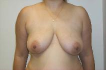 Breast Lift Before Photo by Daniel Casso, MD; Nassau Bay, TX - Case 7720