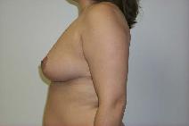 Breast Lift After Photo by Daniel Casso, MD; Nassau Bay, TX - Case 7720