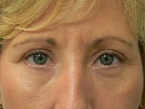 Eyelid Surgery After Photo by Daniel Casso, MD; Nassau Bay, TX - Case 7736