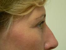 Eyelid Surgery After Photo by Daniel Casso, MD; Nassau Bay, TX - Case 7736