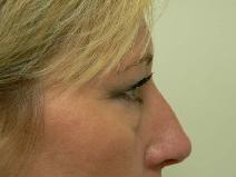 Eyelid Surgery Before Photo by Daniel Casso, MD; Nassau Bay, TX - Case 7736