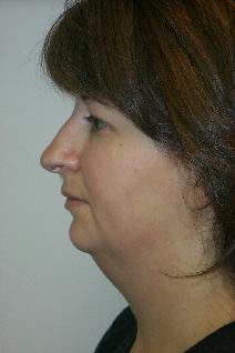 Liposuction Before Photo by Daniel Casso, MD; Nassau Bay, TX - Case 7993