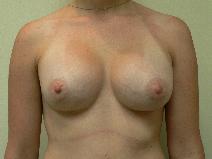 Breast Augmentation After Photo by Daniel Casso, MD; Nassau Bay, TX - Case 8589