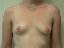 Breast Augmentation Before Photo by Daniel Casso, MD; Nassau Bay, TX - Case 8589