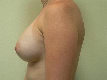 Breast Augmentation After Photo by Daniel Casso, MD; Nassau Bay, TX - Case 8589