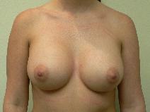 Breast Augmentation After Photo by Daniel Casso, MD; Nassau Bay, TX - Case 9226