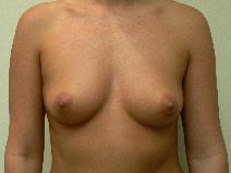 Breast Augmentation Before Photo by Daniel Casso, MD; Nassau Bay, TX - Case 9226
