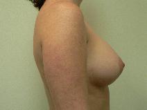 Breast Augmentation After Photo by Daniel Casso, MD; Nassau Bay, TX - Case 9226