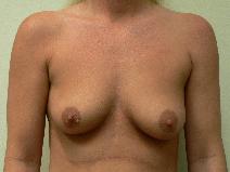 Breast Augmentation Before Photo by Daniel Casso, MD; Nassau Bay, TX - Case 9425