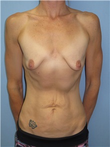 Breast Augmentation Before Photo by Howard Heppe, MD; Fredericksburg, VA - Case 32967