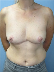 Breast Reduction After Photo by Howard Heppe, MD; Fredericksburg, VA - Case 32970