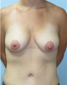 Breast Augmentation After Photo by Howard Heppe, MD; Fredericksburg, VA - Case 32974