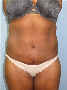 Tummy Tuck After Photo by Howard Heppe, MD; Fredericksburg, VA - Case 33104