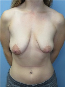 Breast Lift Before Photo by Howard Heppe, MD; Fredericksburg, VA - Case 35408