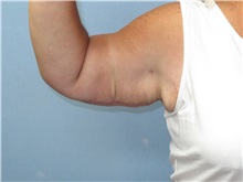 Arm Lift After Photo by Howard Heppe, MD; Fredericksburg, VA - Case 35409