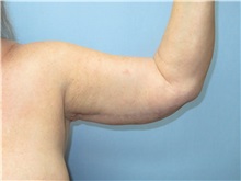 Arm Lift After Photo by Howard Heppe, MD; Fredericksburg, VA - Case 35410