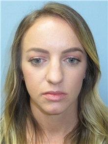 Rhinoplasty Before Photo by Howard Heppe, MD; Fredericksburg, VA - Case 35841