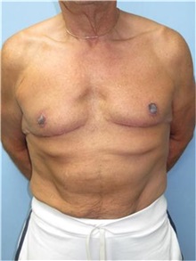 Male Breast Reduction After Photo by Howard Heppe, MD; Fredericksburg, VA - Case 35843