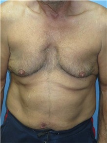 Male Breast Reduction Before Photo by Howard Heppe, MD; Fredericksburg, VA - Case 35843