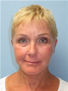 Facelift After Photo by Howard Heppe, MD; Fredericksburg, VA - Case 36158