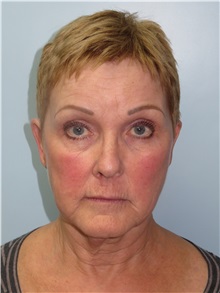 Facelift Before Photo by Howard Heppe, MD; Fredericksburg, VA - Case 36158