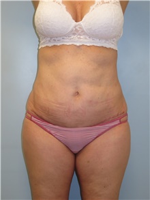 Tummy Tuck After Photo by Howard Heppe, MD; Fredericksburg, VA - Case 41325