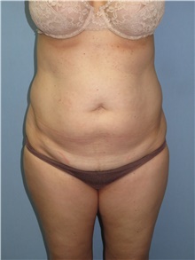 Tummy Tuck Before Photo by Howard Heppe, MD; Fredericksburg, VA - Case 41325
