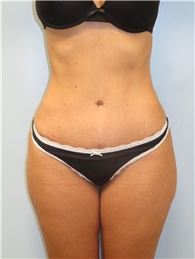 Tummy Tuck After Photo by Howard Heppe, MD; Fredericksburg, VA - Case 41326