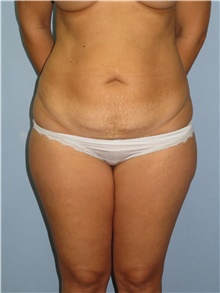 Tummy Tuck Before Photo by Howard Heppe, MD; Fredericksburg, VA - Case 41326