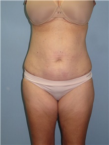 Tummy Tuck After Photo by Howard Heppe, MD; Fredericksburg, VA - Case 41327