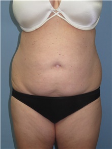 Tummy Tuck Before Photo by Howard Heppe, MD; Fredericksburg, VA - Case 41327