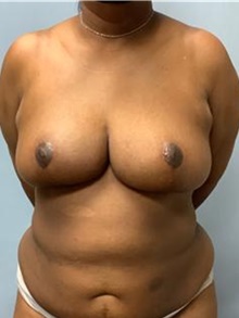 Breast Reduction After Photo by Howard Heppe, MD; Fredericksburg, VA - Case 45510