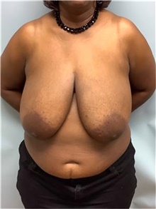 Breast Reduction Before Photo by Howard Heppe, MD; Fredericksburg, VA - Case 45510