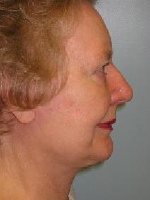 Facelift After Photo by Howard Heppe, MD; Fredericksburg, VA - Case 6647