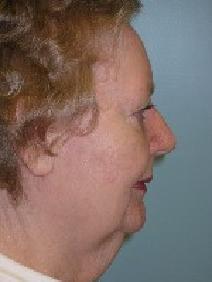 Facelift Before Photo by Howard Heppe, MD; Fredericksburg, VA - Case 6647