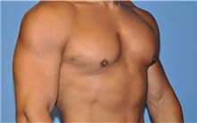 Male Breast Reduction After Photo by Robert Wilcox, MD; Plano, TX - Case 30105