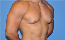 Male Breast Reduction Before Photo by Robert Wilcox, MD; Plano, TX - Case 30105