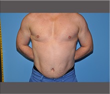 Male Breast Reduction After Photo by Robert Wilcox, MD; Plano, TX - Case 30125
