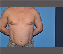 Male Breast Reduction Before Photo by Robert Wilcox, MD; Plano, TX - Case 30125